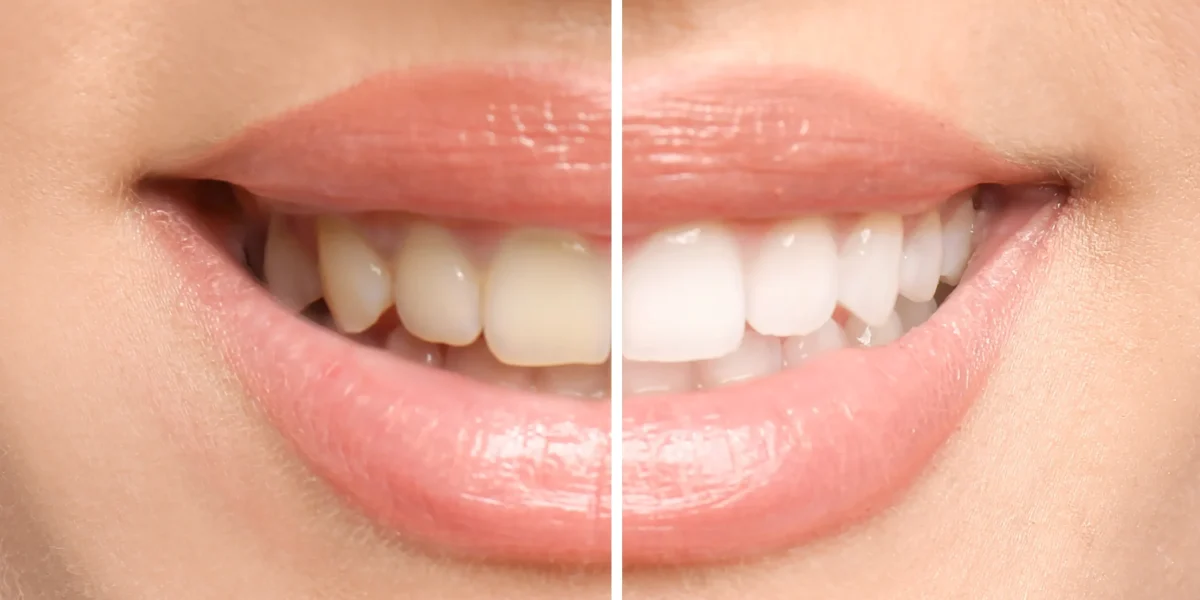658c3f7782f787771b1e0e73_Fluoride Treatment