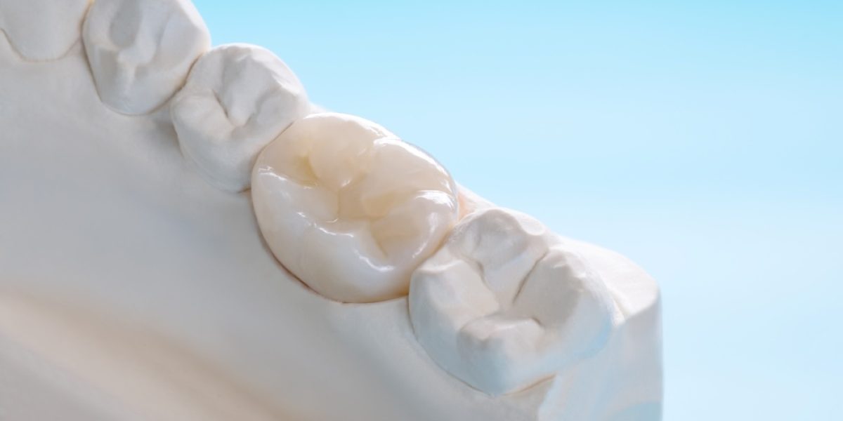 EmergencyDentalCrownsLangston