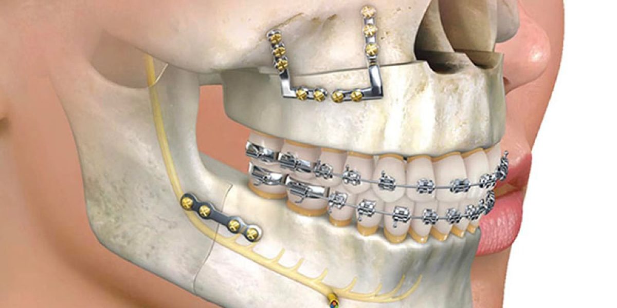 pinnacle-oral-surgery-rockwall-texas-orthognathic-surgery-v2