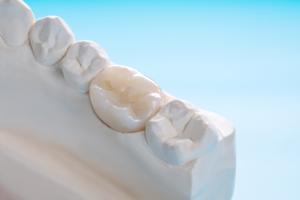 EmergencyDentalCrownsLangston